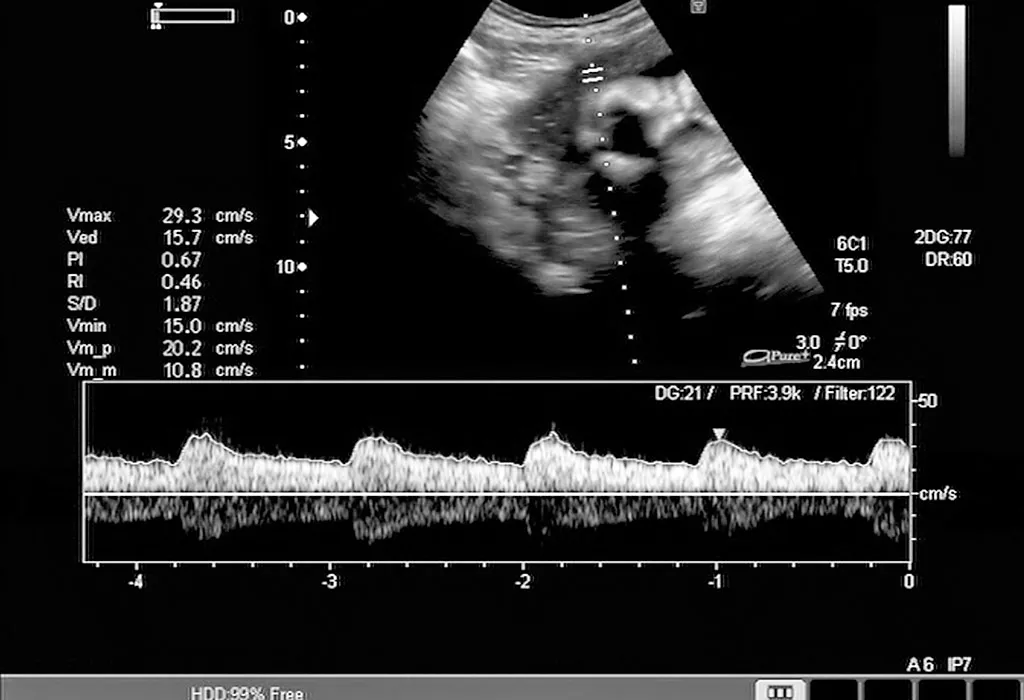 FOETAL HEARTBEAT FOETAL HEARTBEAT