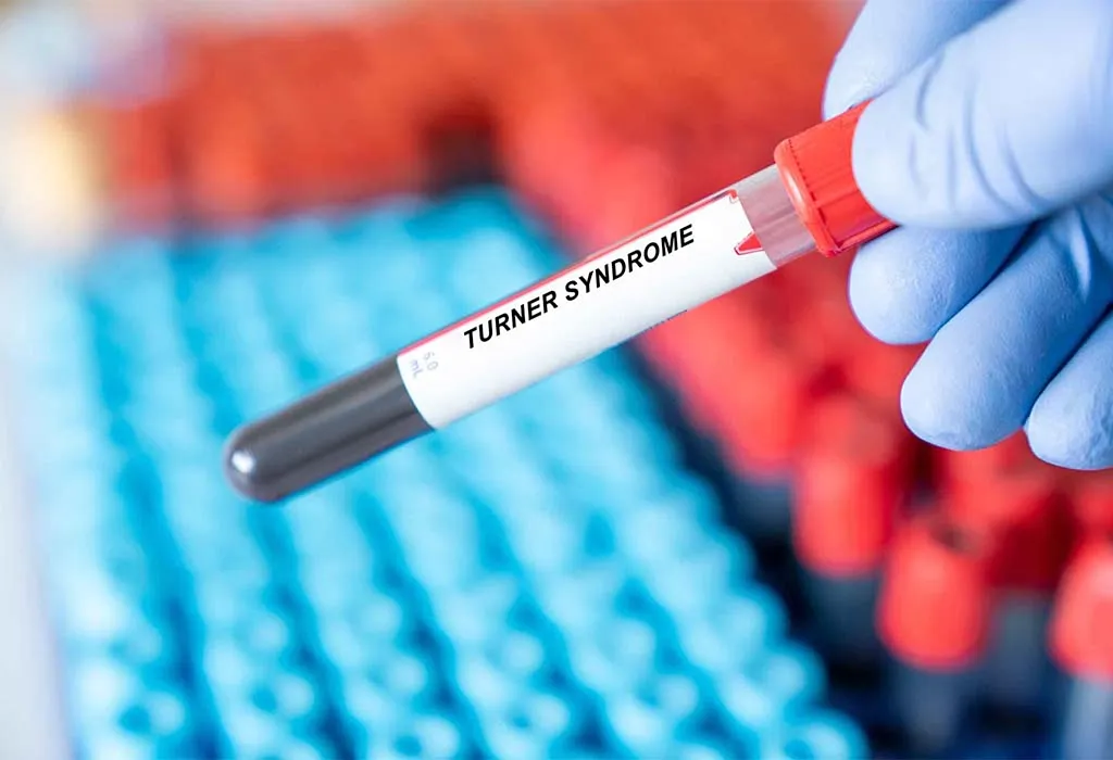 turner syndrome