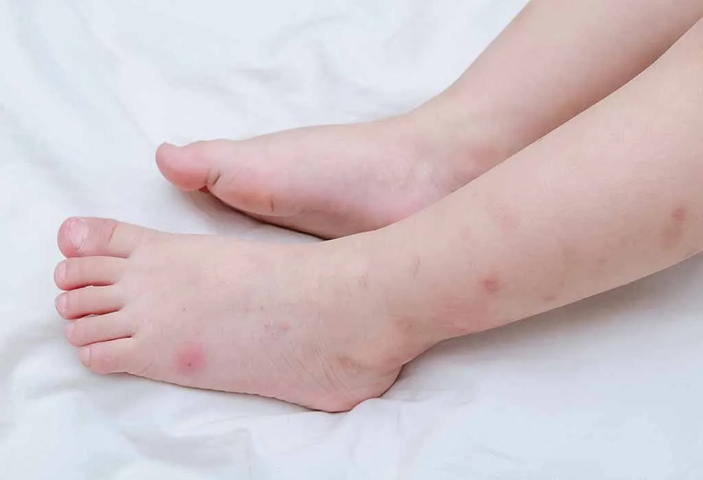 bed bug bites on black babies