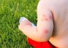 शिशुओं और बच्चों को खटमल का काटना - खतरे और इलाज