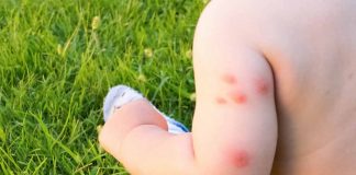 शिशुओं और बच्चों को खटमल का काटना - खतरे और इलाज