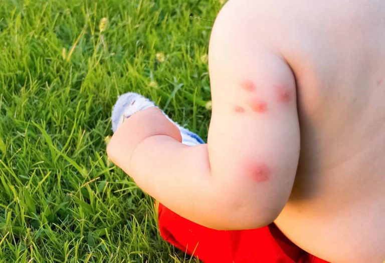 Bed Bug Bites on Babies and Children- Health Risks and Treatment