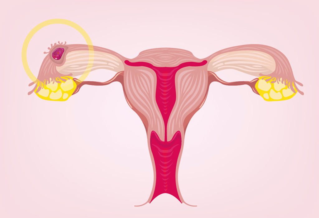 ECTOPIC PREGNANCY