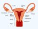 Endometrial Thickness