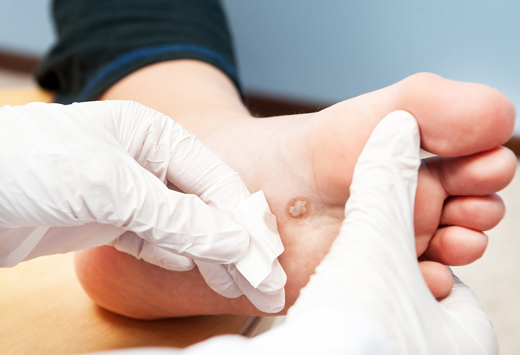 wart on foot and pregnancy