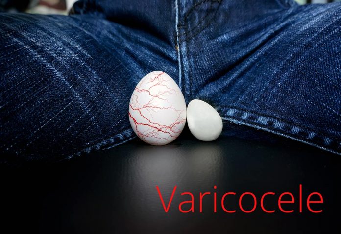 Varicocele and Infertility
