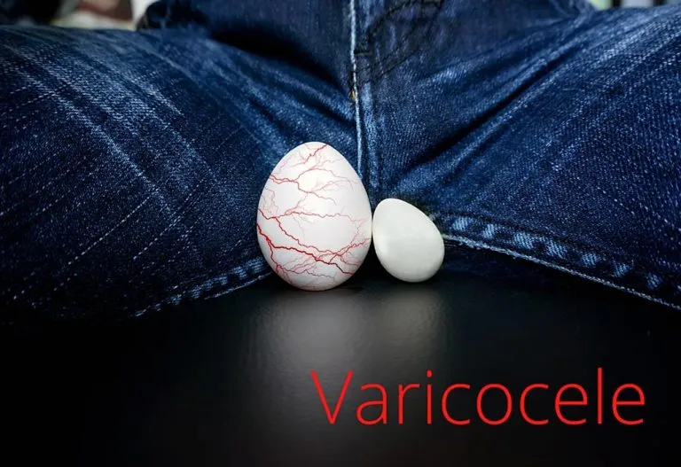 Varicocele and Infertility
