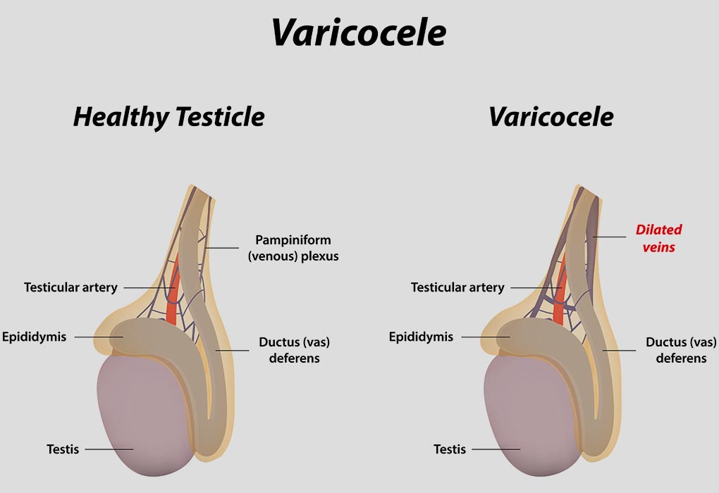 presentation of varicocele