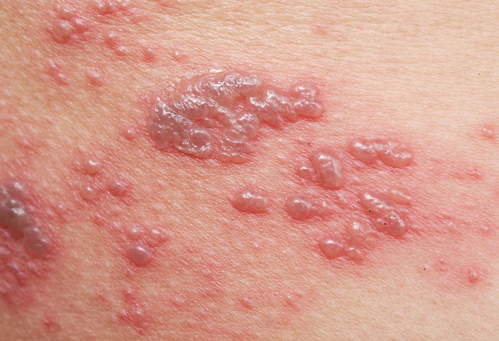 Shingles and Pregnancy – Are You At Risk?
