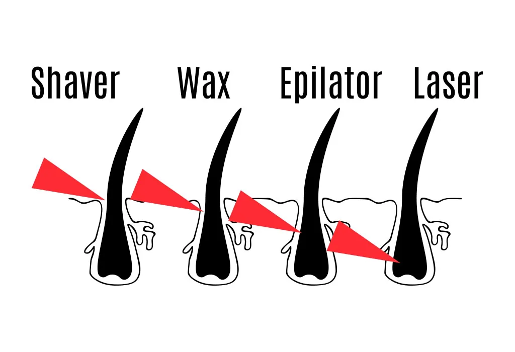 Wie effektiv ist die Haarentfernung mit Laser?