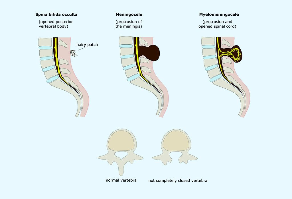 Causes of Hydrocephalus in Babies