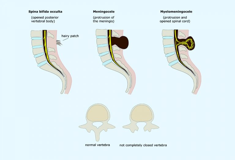 Hydrocephalus in Babies - Causes, Signs & Treatment