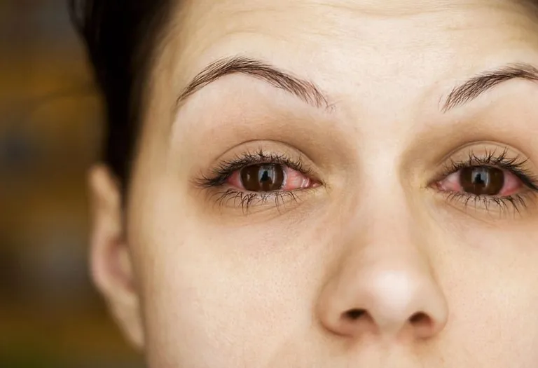 Conjunctivitis (Pink Eye) During Pregnancy