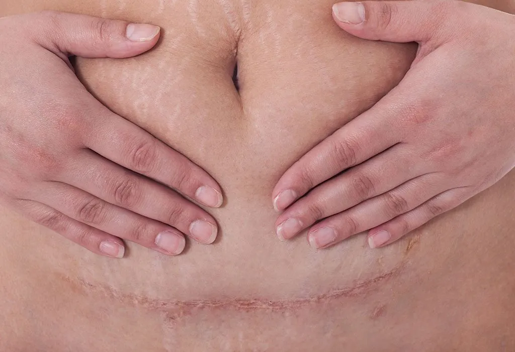 C-Section Scar Infection - Types, Reasons, Signs & Treatment
