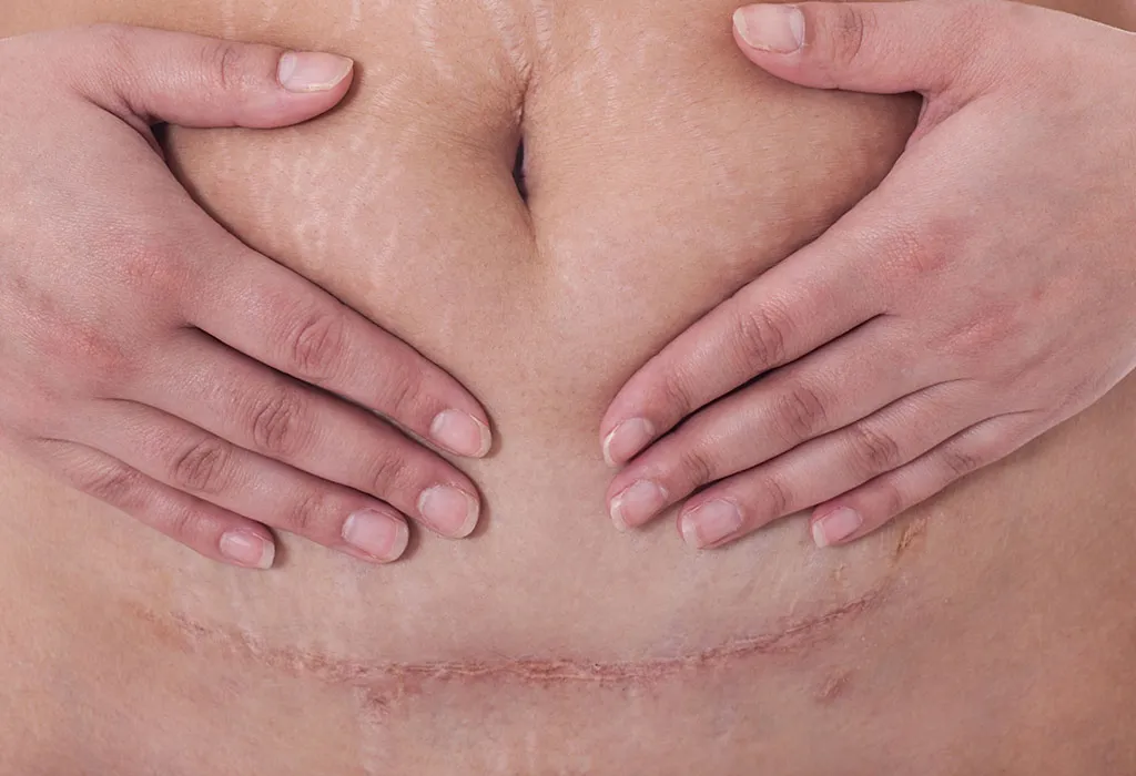 C-Section Scars: What to Expect and How to Help Them Heal