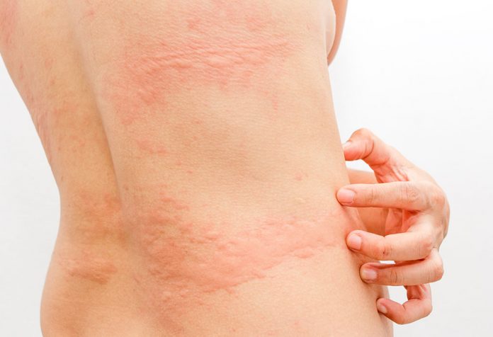 How To Relieve Hives While Breastfeeding