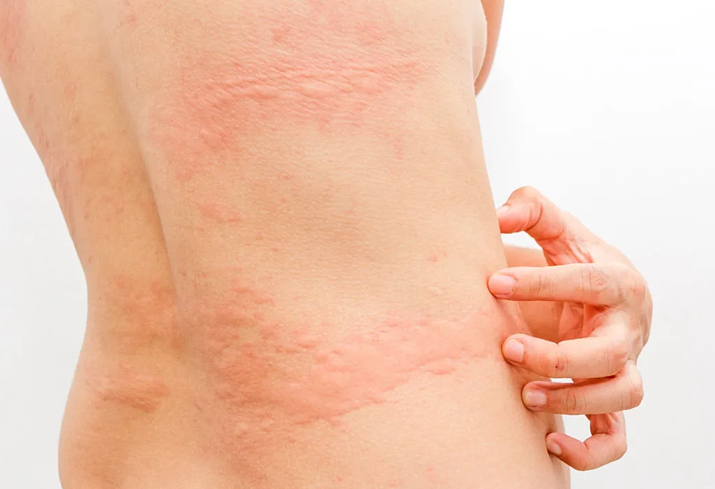 How do you get rid of hives from an allergic reaction