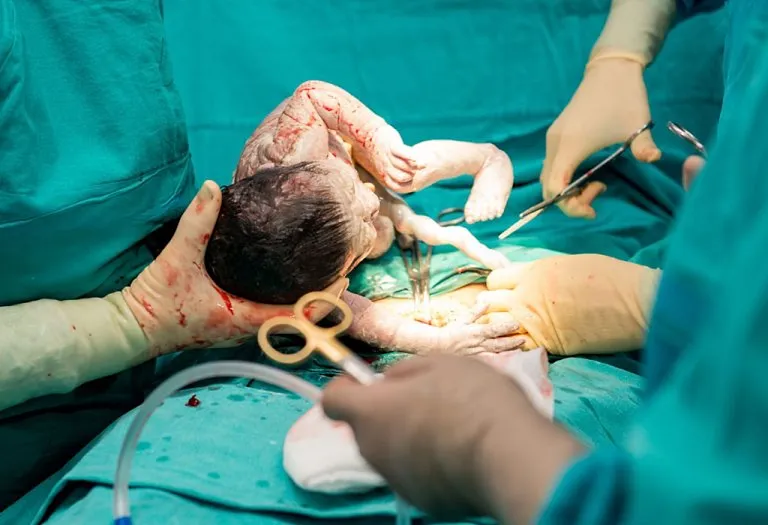 Multiple or Repeat Caesarean Section - Benefits and Risks