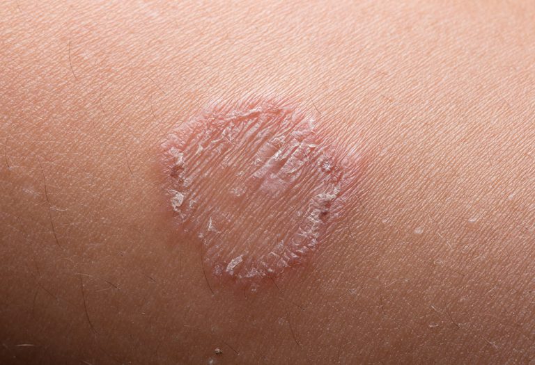 Ringworm in Kids - Causes, Symptoms and Treatment