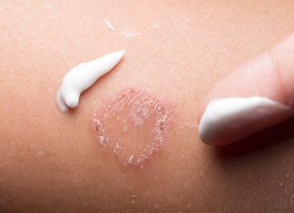 গর্ভাবস্থায় দাদ