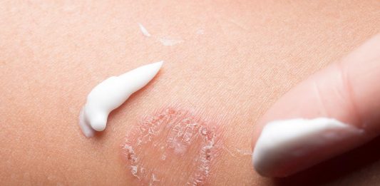 গর্ভাবস্থায় দাদ – লক্ষণ, প্রভাব এবং প্রতিকার গর্ভাবস্থায় দাদ