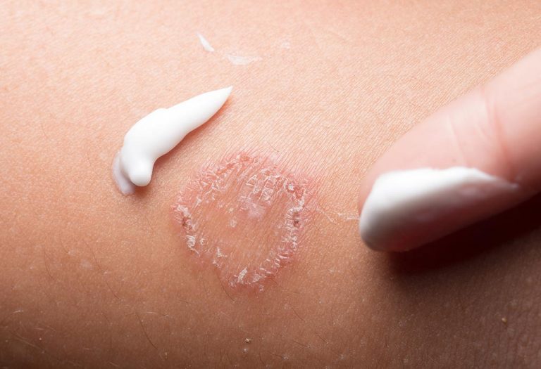 Ringworm During Pregnancy - Signs, Effects, and Remedies