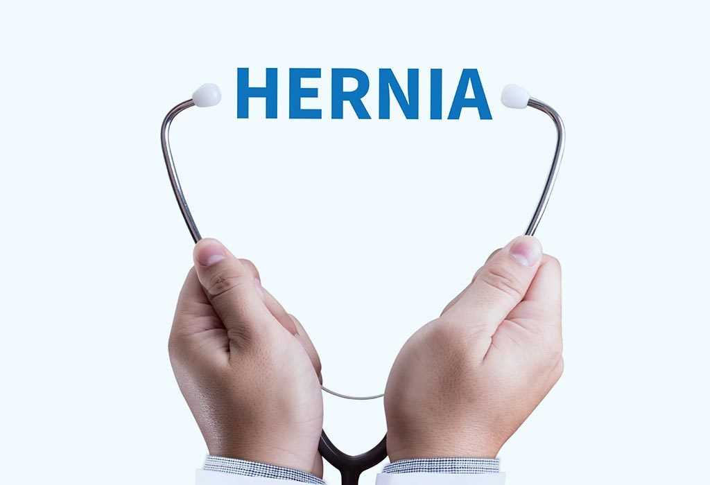 Umbilical Hernia After Pregnancy