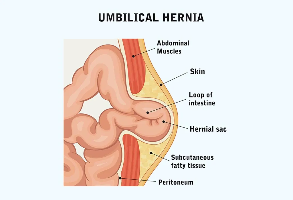 Causes of Post Delivery Umbilical Hernia