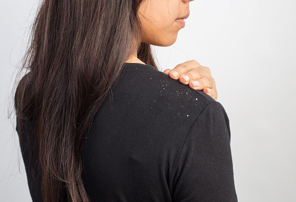 Dandruff During Pregnancy – Causes and Remedies