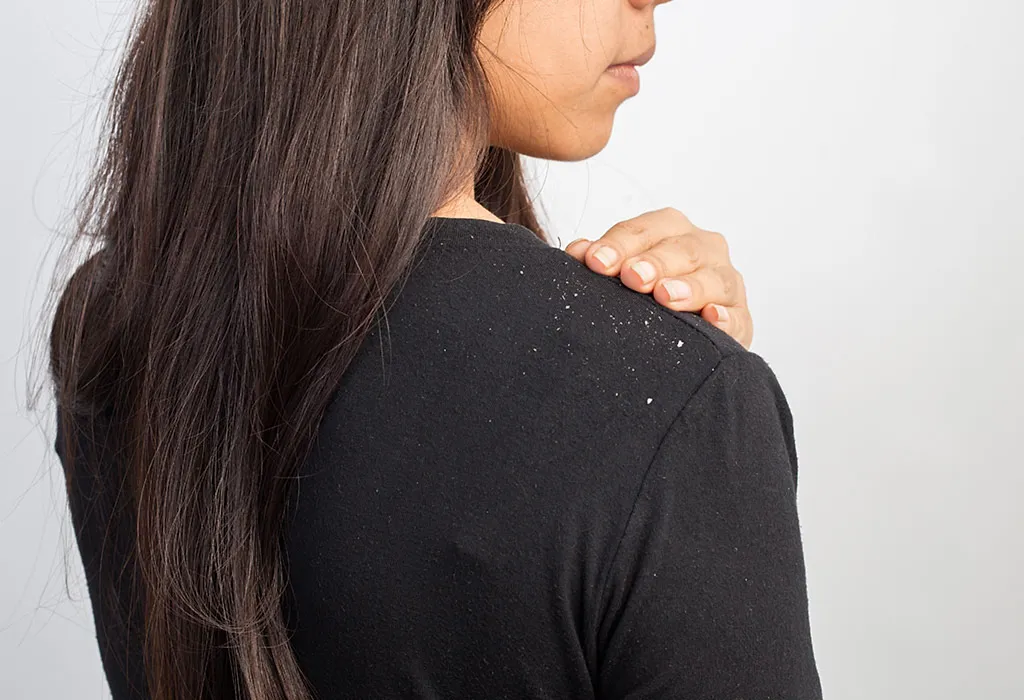 Dandruff While Pregnant: Causes, Treatment and Prevention