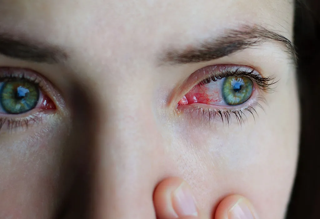 Conjunctivitis or Pink Eye Conjunctivitis or Pink Eye