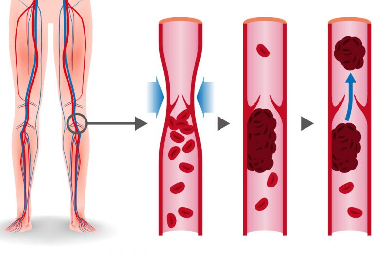 Having Multiple or Repeat C-Section: Benefits, Risks & more