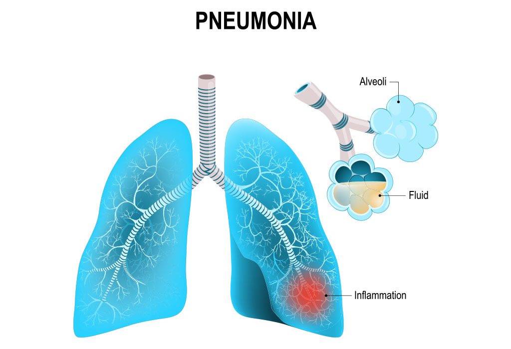  Pneumonia