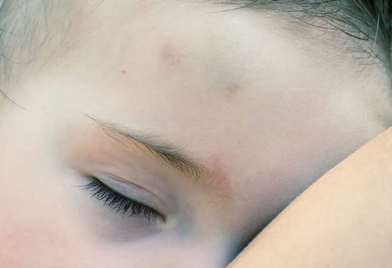 Infant Bruising - Causes and Remedies