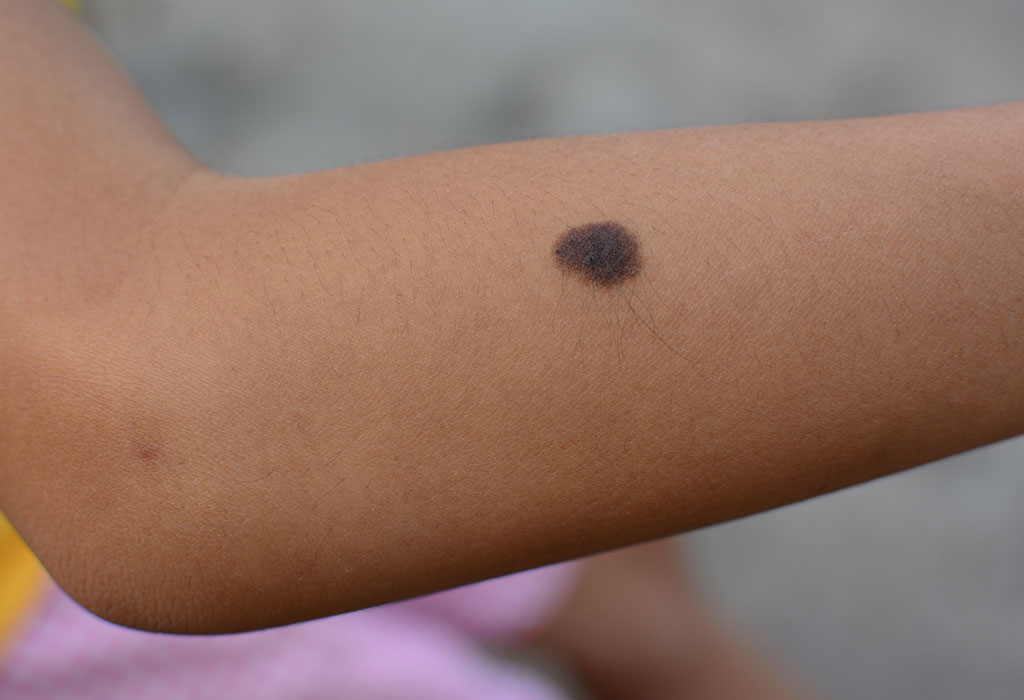 When should a child's mole or wart be checked? 