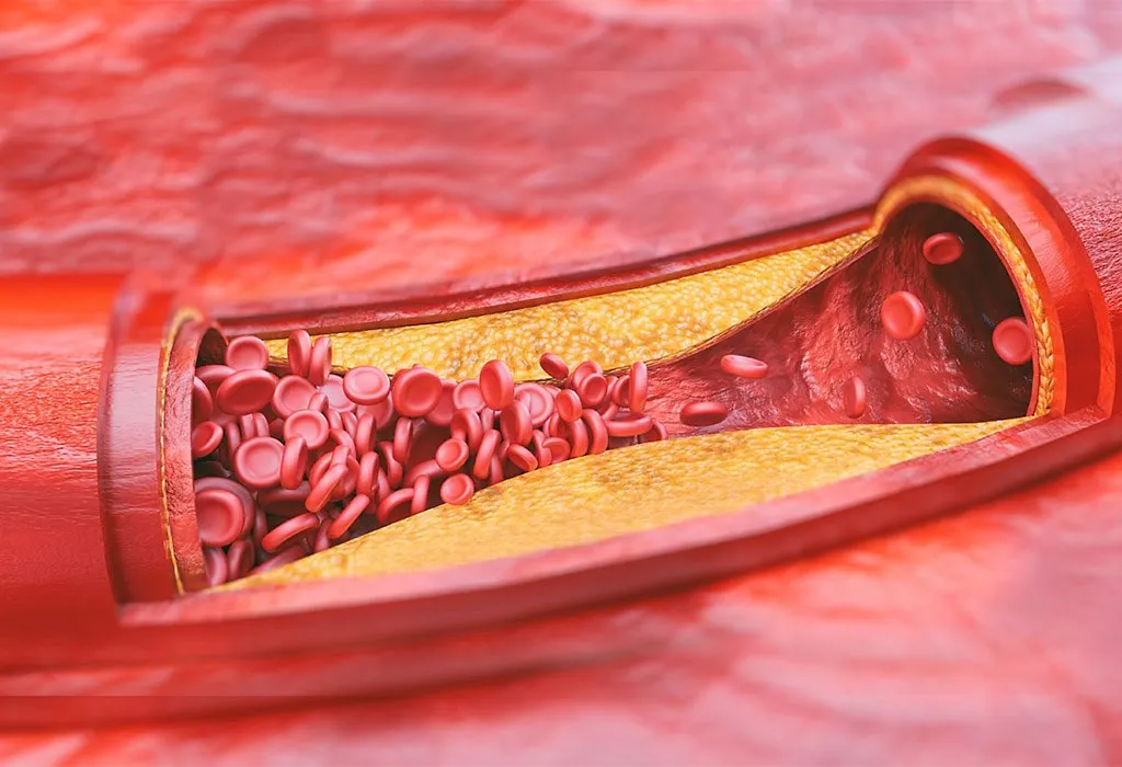 Signs and Symptoms of High Cholesterol - atherosclerosis