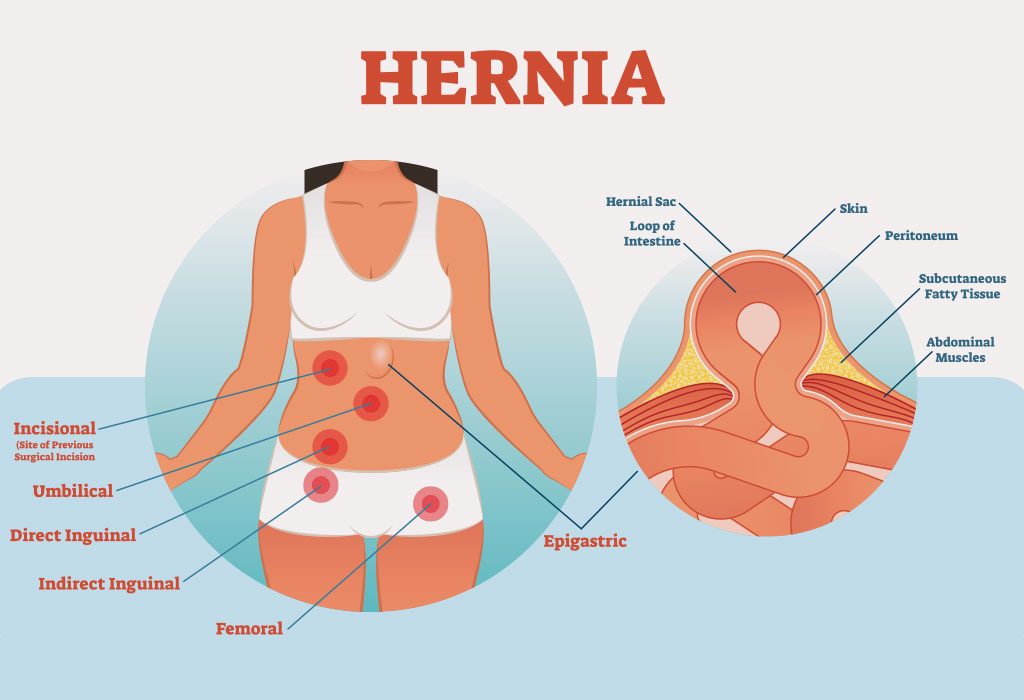 Hernia After Caesarean Delivery Causes Symptoms Treatment