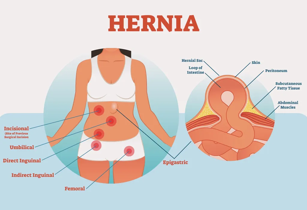 Postpartum Hernia: Understanding The Connection to C-Sections - G