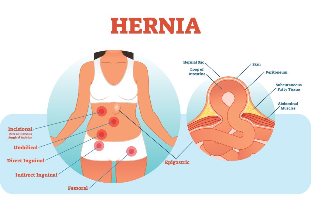 Paraumbilical Hernia