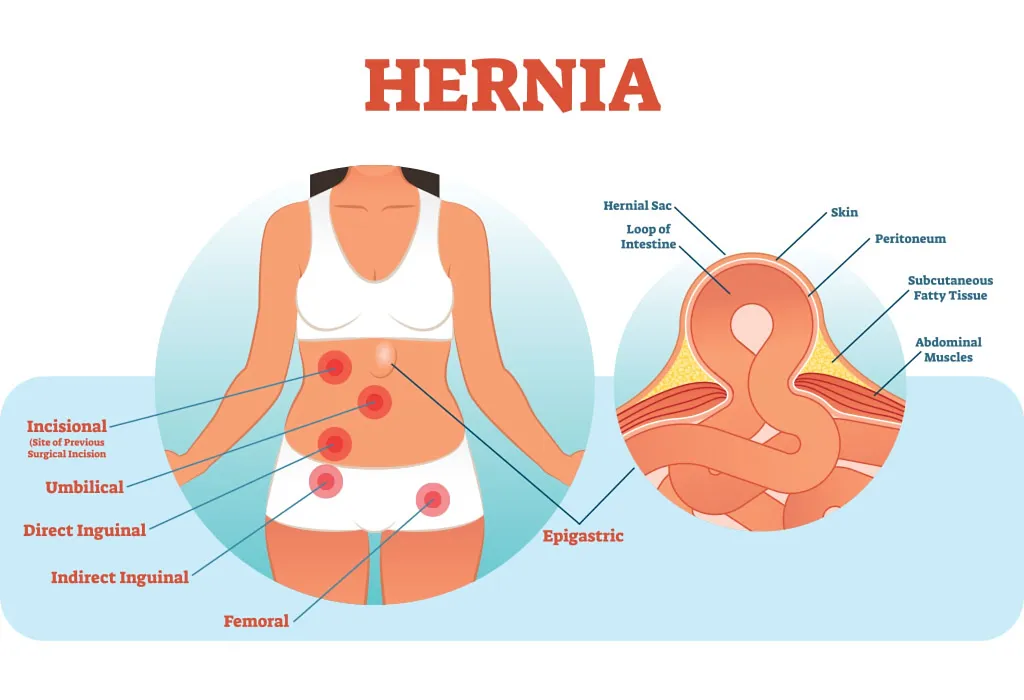 Pregnancy hernia