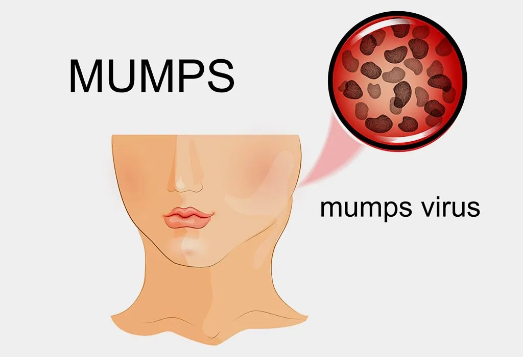How Common Is Mumps in Pregnant Women?
