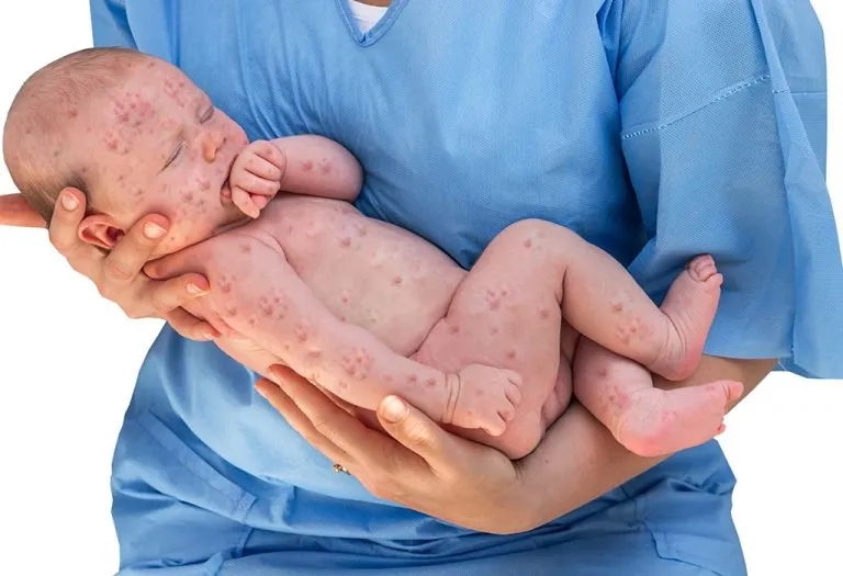 Rubella (German Measles) in Babies and Kids