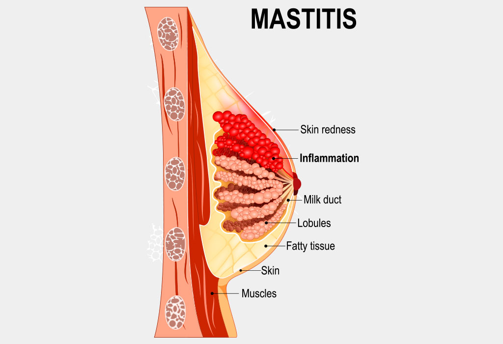 Mastitis