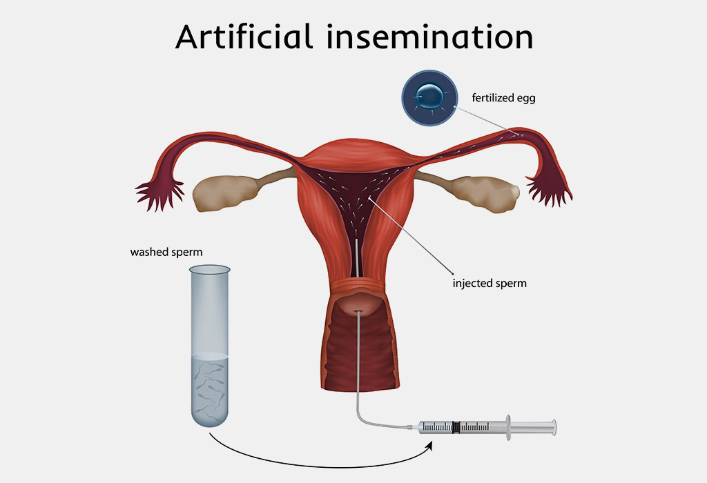 Insémination artificielle