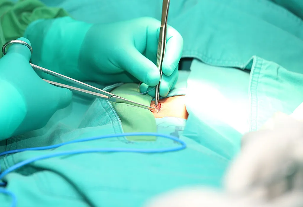 Pregnancy Hernia Treatment