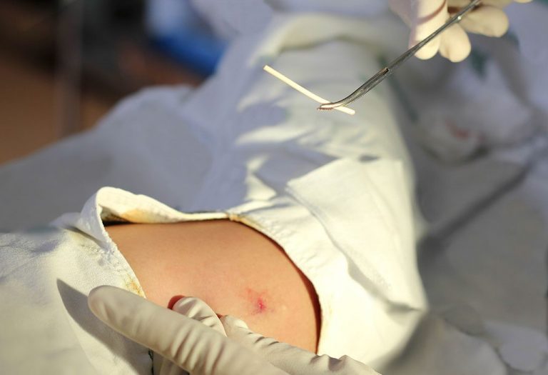 Birth Control Implant (Contraceptive Implant) - Benefits, Side Effects & Cost