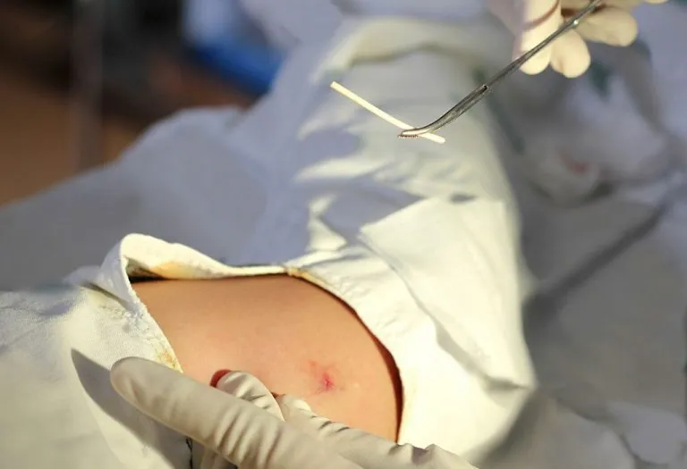 Birth Control Implant (Contraceptive Implant) - Benefits, Side Effects & Cost