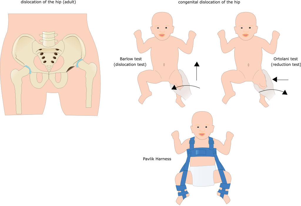 العلاج الطبيعي لخلع الورك الولادي- حزام بافليك
