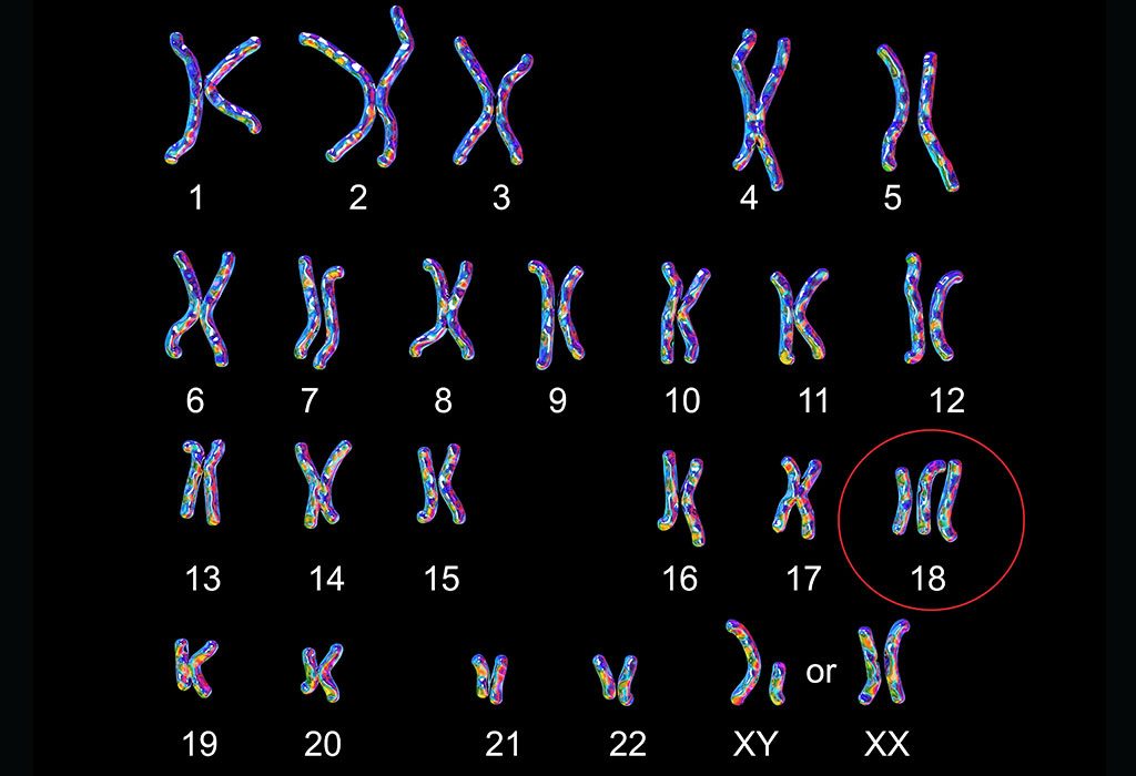 Karyotype Of Person With Edwards Syndrome