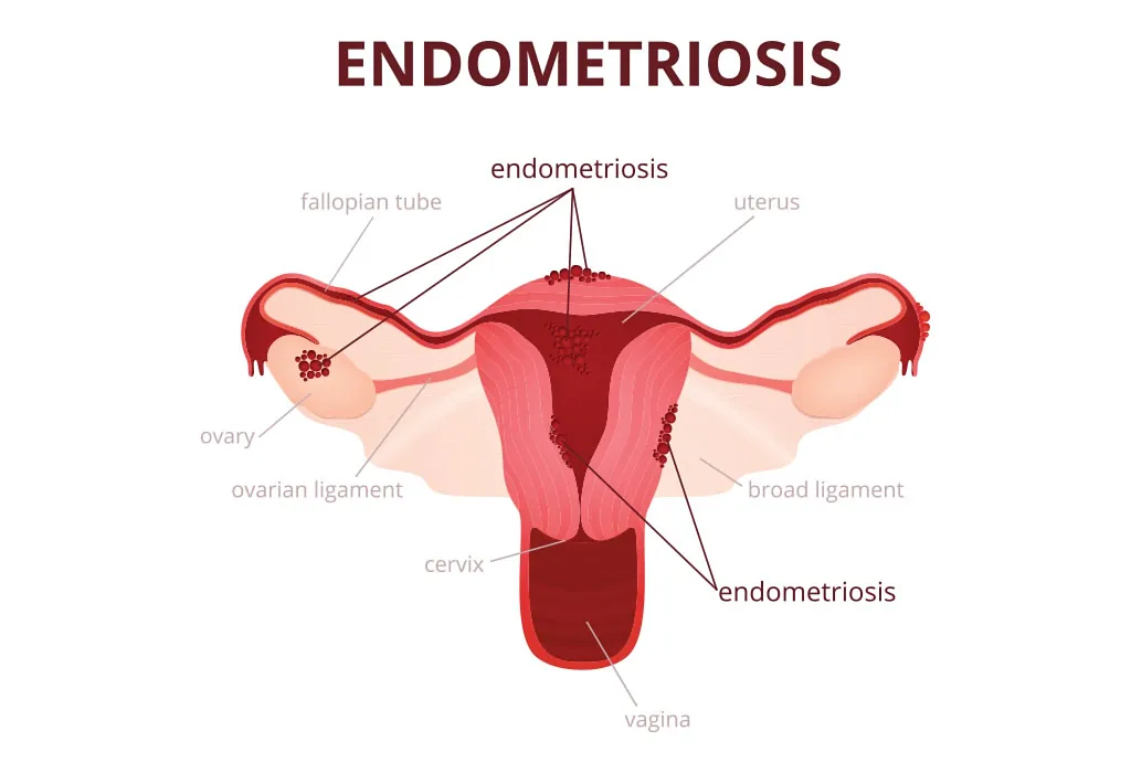 Endometriosis explained Endometriosis explained